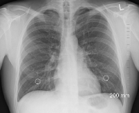 Mieszkańcy powiatu sanockiego, brzozowskiego i leskiego mogą skorzystać z darmowej tomografii płuc